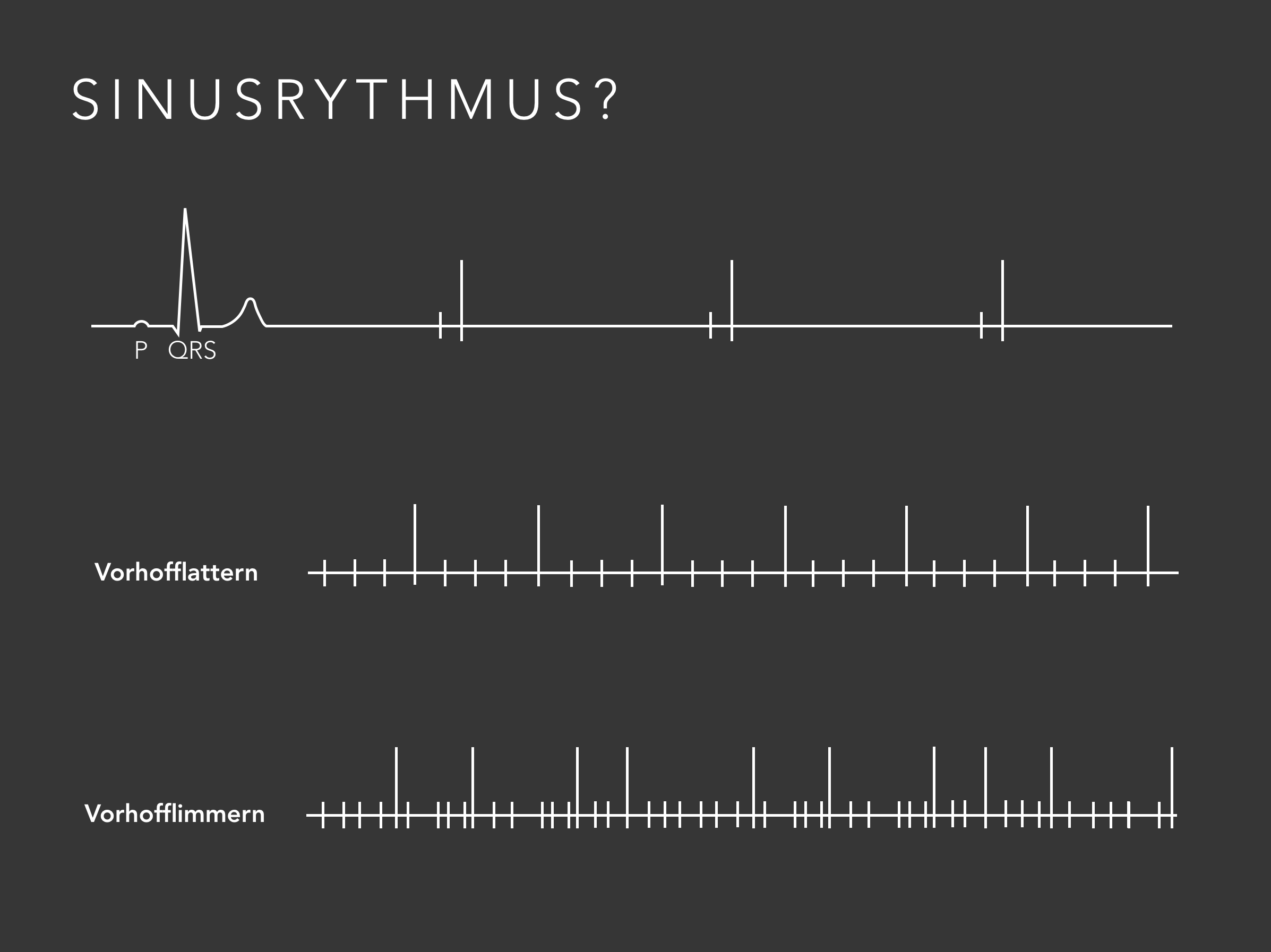 Sinusrhythmus.png