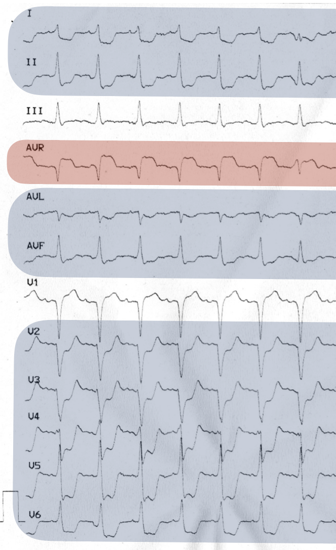 aVR.png